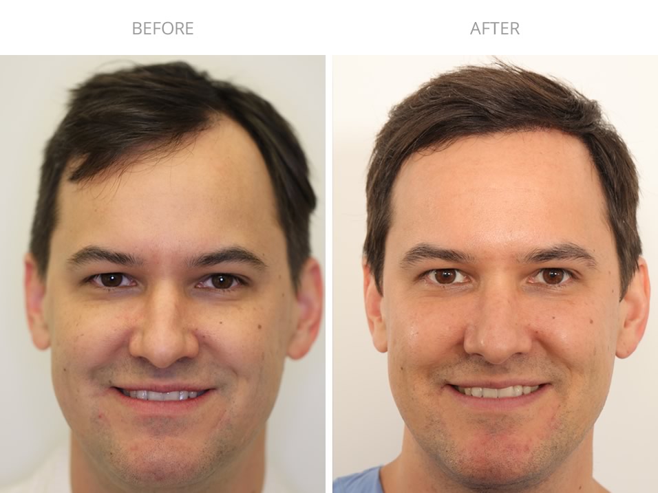 Finding the Right Hair Transplant Surgeon in New York
