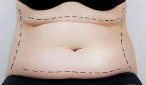 Talk to Your Doctor About Abdominoplasty in Miami